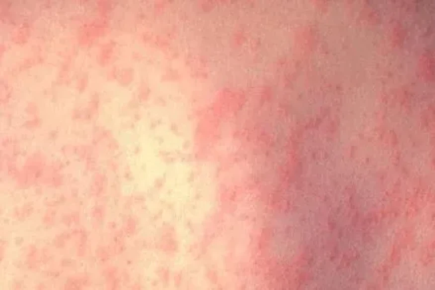 La France marquée par une flambée de rougeole avec près de 500 cas enregistrés en 2024, soit quatre fois plus qu'en 2023, indique Santé publique France